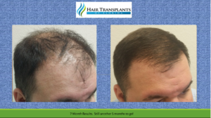 Tampa hair restoration before after videos