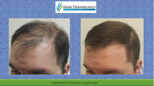 Orlando Hair Transplants Before After Videos