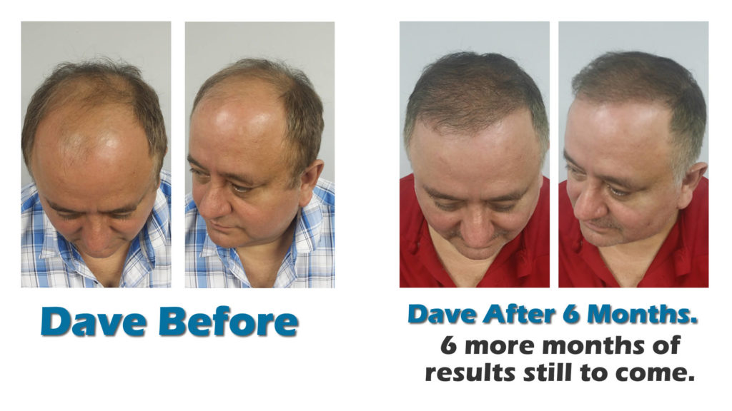 Orlando hair transplants before after photos and video