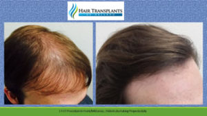 Orlando hair loss center before after photo