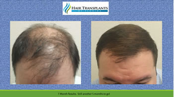hair transplants Orlando before after photo