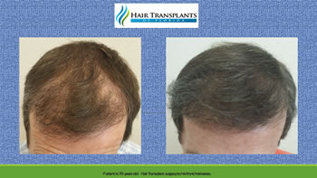 hair transplants Orlando before after photo
