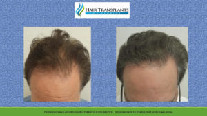 Hair Loss MD before after hair restoration photo