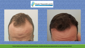 Hair Transplant Before After Photos