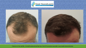 Hair Transplant Before After Photos from Orlando Hair MD