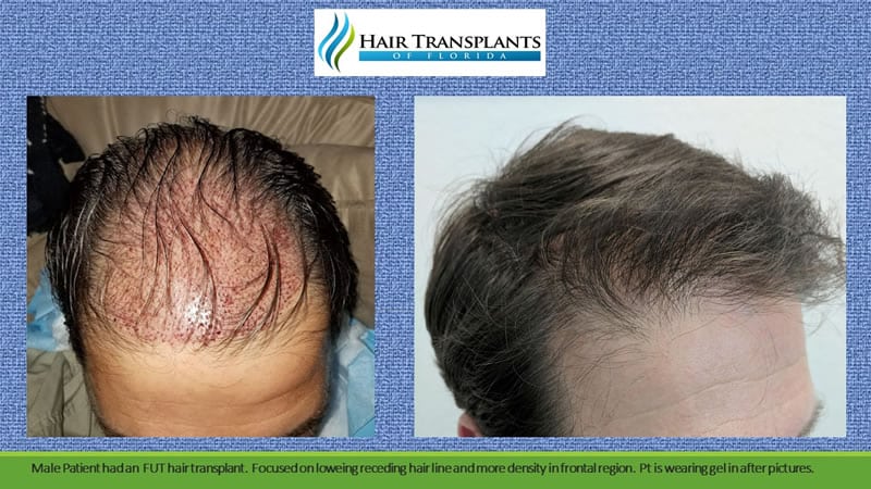 Hair Transplant Cost in Ahmedabad, Cost of hair transplant in Ahmedabad -  Medlife