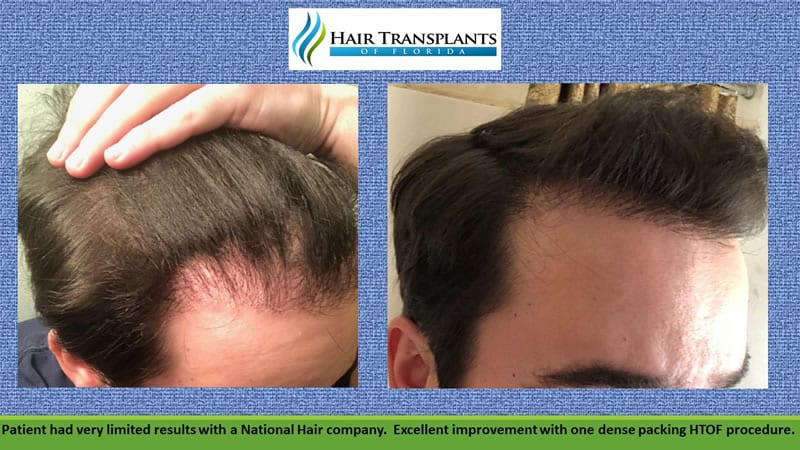Hair loss - Diagnosis and treatment - Mayo Clinic