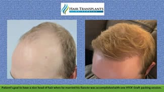 Hair Transplants by Board Certified Surgeon at Hair Transplants of Florida