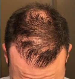 Tampa Hair Transplant Results