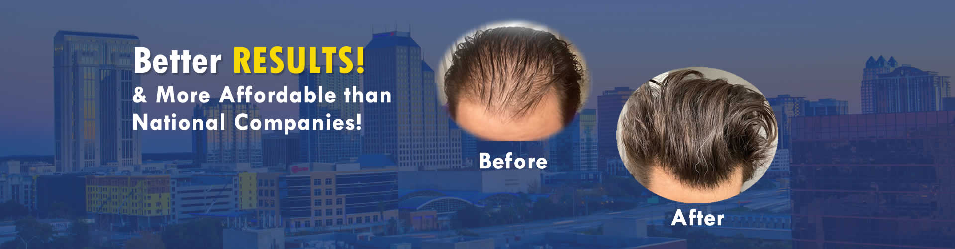Best Hair Transplant Results in Orlando