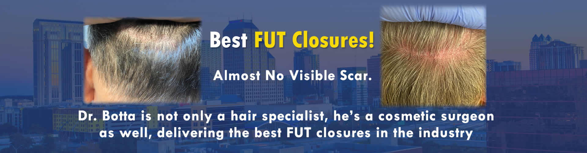 Best FUT closures with no Scar hair transplants